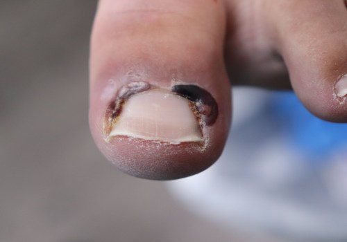 What kills toenail fungus permanently?
