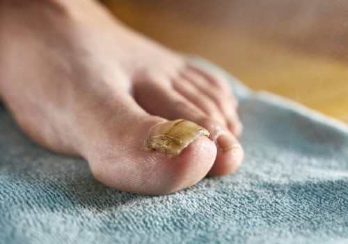 Expert Tips for Treating Thick Toenails: From a Dermatologist's Perspective