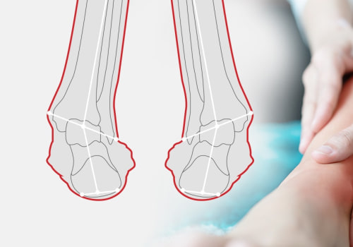 Supination vs Pronation of the Foot Explained: Learn How Improper Foot Mechanics Can Lead to Pain